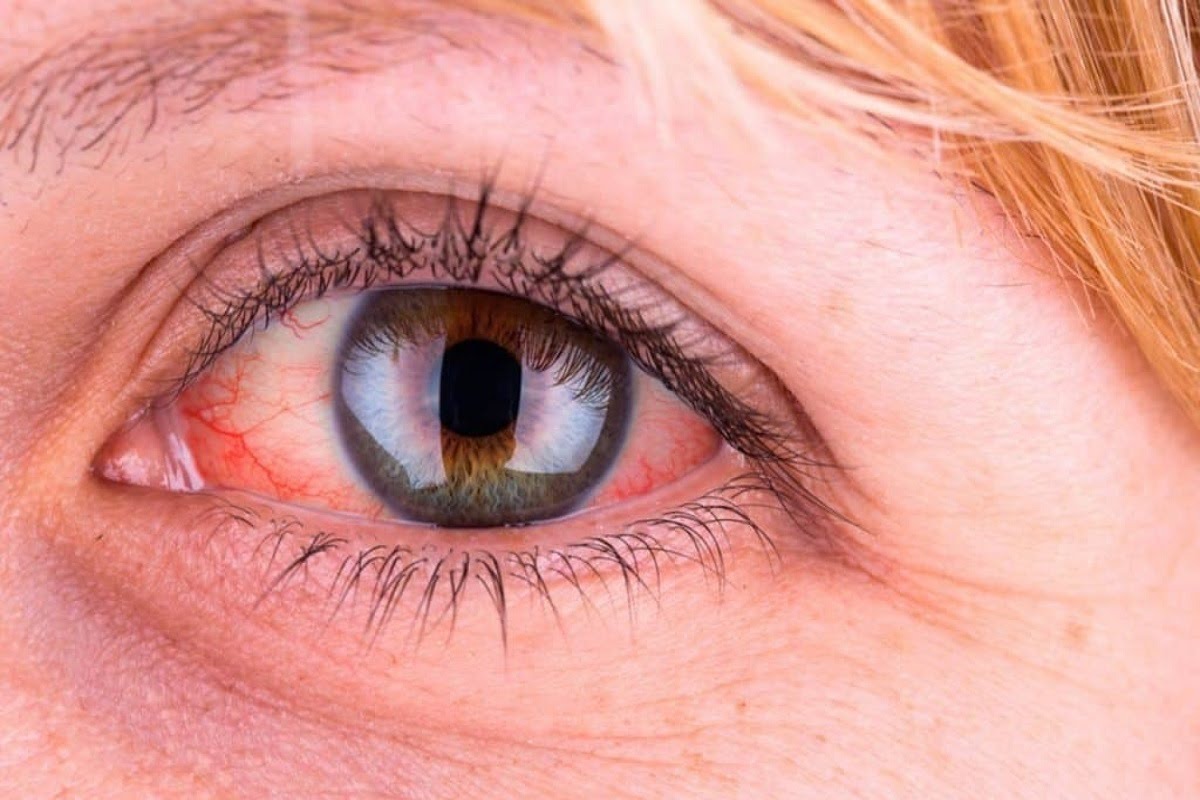قرمزی چشم و دلایل مهم ان