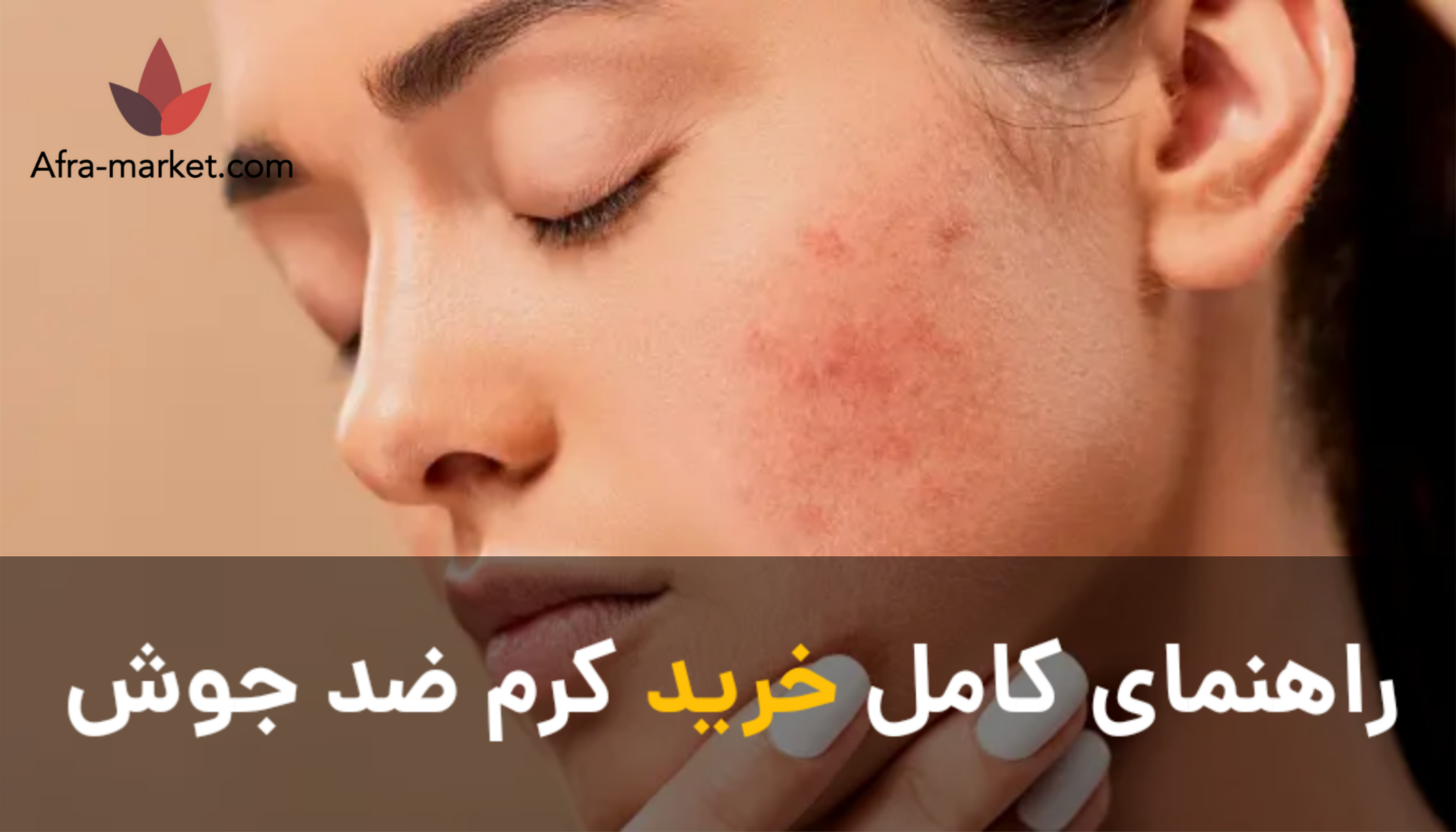 راهنمای کامل خرید کرم ضد جوش | معرفی بهترین محصولات درمان جوش