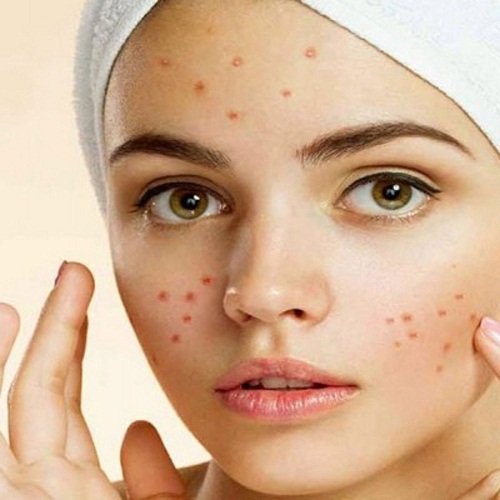 فروش کرم ضد جوش و لک صورت..