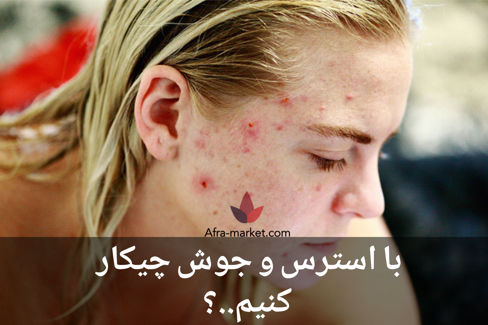 تأثیر استرس بر پوست | چرا استرس باعث جوش و پیری زودرس می‌شود؟