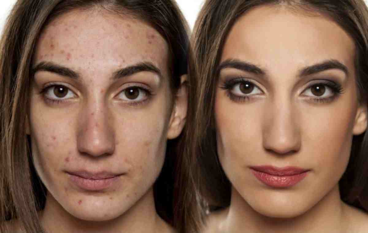 آماده‌سازی پوست مستعد آکنه برای آرایش