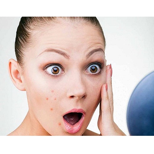 درمان آکنه و جوش صورت با محصولات آرایشی و بهداشتی
