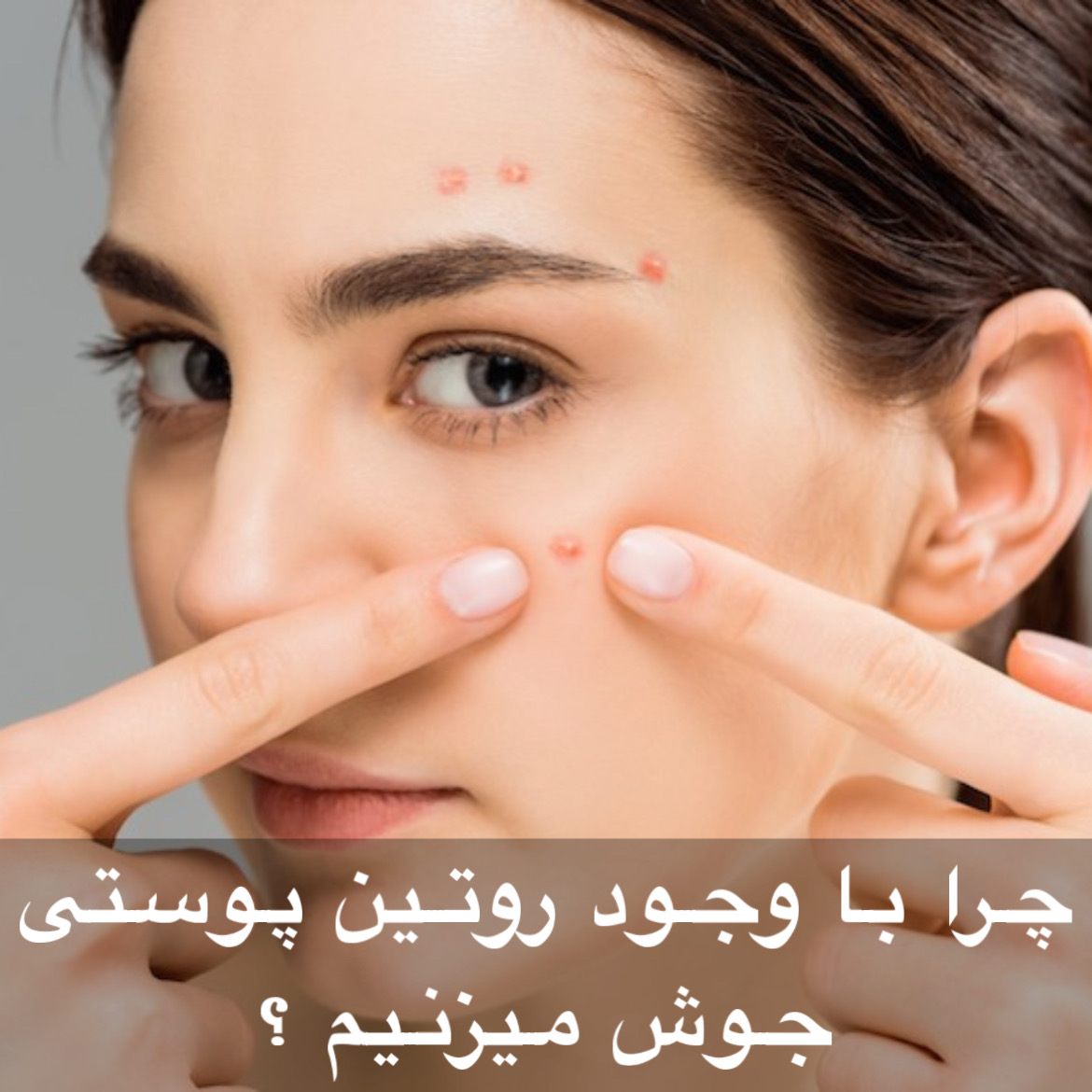 چرا با وجود روتین پوستی هنوز جوش می‌زنم؟ | ۷ دلیل پنهان که کسی نمی‌گوید